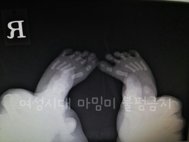 생후 1일 갓난아기 엑스레이 흥미돋!!? | 인스티즈