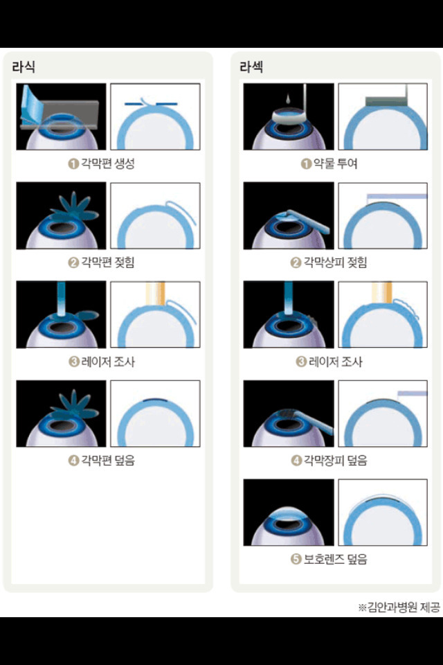 라섹과 라식의 차이 | 인스티즈