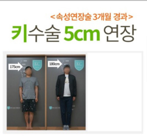 키 크는 수술 | 인스티즈
